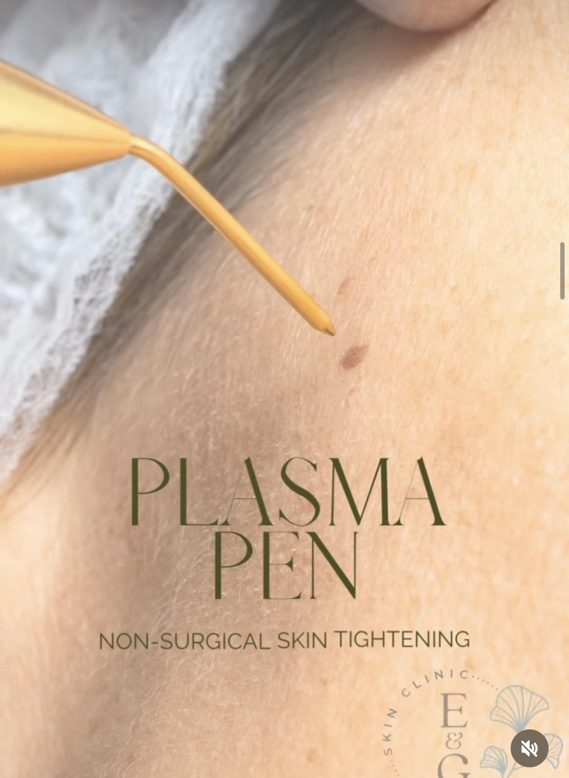 Plasma Pen egskinclinic