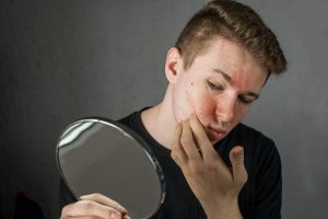 How to Care for Eczema Prone Skin During the Winter Months