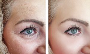 Ozempic, What is does to your skin