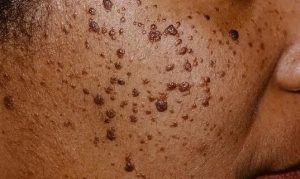 DPN Removal in Edinburgh: What You Need to Know