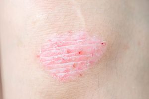 Psoriasis Awareness Month: What Edinburgh Patients Need to Know About Flare-Ups, Scalp Care, and Eczema Look-Alikes