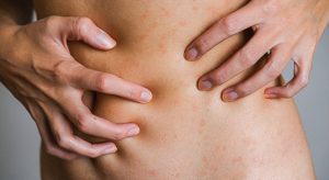 Proven Tips to Stop Dermatitis Flare-Ups Now