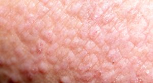 Beating the Autumn Itch: How to Protect Your Skin Barrier in Scotland